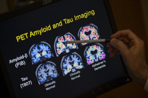 How a new blood test to detect Alzheimer’s disease can help stop memory loss earlier