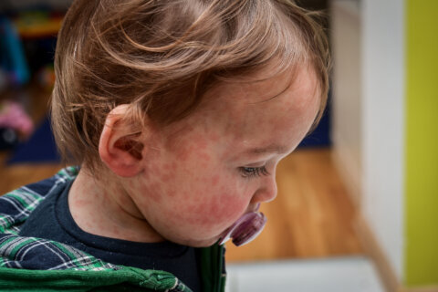 Frequently asked questions that doctors get about measles