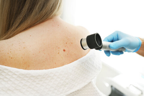 What you should know about sunscreen and skin cancer